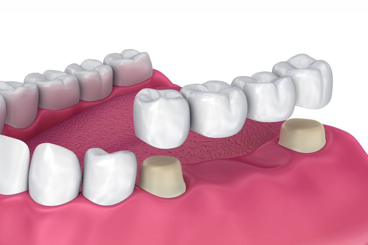 Dental Crowns